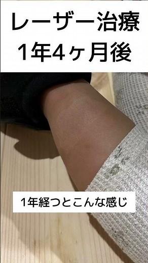 異所性蒙古斑レーザー治療の術後経過