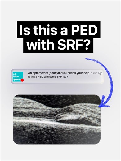 An optometrist wanted an opinion on whether this was a PED with subretinal fluid on the Ask Fellow Optoms app. Others' responded leaning towards SRF being present, with central serous chorioretinopathy and wet AMD being the top differentials. So what are the key lessons? Firstly, the consensus quickly pointed towards SRF, highlighting the importance of recognizing its appearance. Secondly, when faced with SRF, think CSR, especially considering the patient's sex, age, and stress levels, but alway