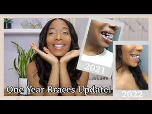 1 YEAR WITH BRACES UPDATE! | Closing Gaps, Elastics, Power Chains!