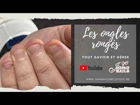Les ongles rongés, tout savoir et gérer 😃💪
