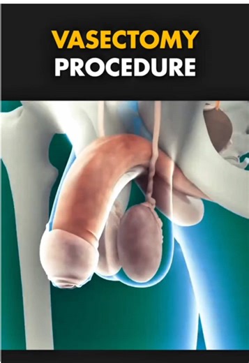 Understanding the Vasectomy Procedure Through 3D Animation