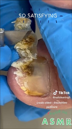 Toe Fungus Removal: Nail Cleaning and Podiatry ASMR