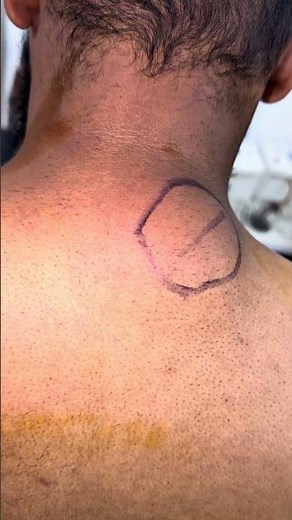Neck lipoma