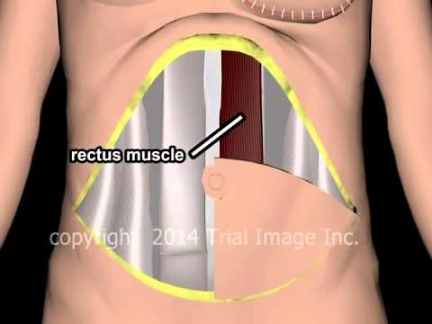Breast Reconstruction (TRAM) - animation & narration by Cal Shipley, M.D.