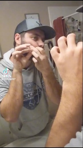 pimplepopping.tv on Instagram: "Colossal pop with audible squirts . . . : #pimple #pimplepopping #pores #pimplepop #pimples #acne #blackheads #whiteheads #blackheads #blackheadremover #blackhead"