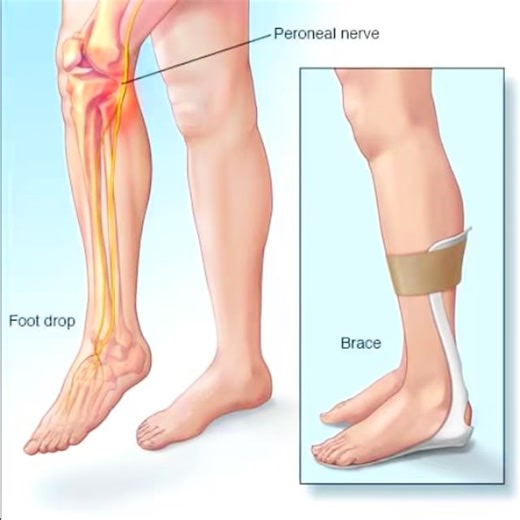 Foot Drop Treatment | Re-Health | Physiotherapy | Neuro Rehab | #physio #physiotherapy #physiotherapist #medical #trending #trending #instagood #instagood #medico | Re-Health Education | Facebook