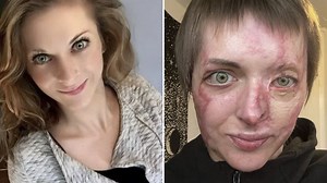 Half my face melted off as I celebrated date night - I felt like a monster