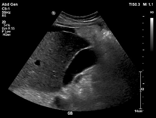 Focused Gallbladder Ultrasound - Enhance your Skills!