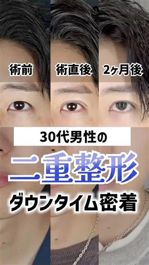 [Men's Plastic Surgery] A close look at the recovery period after double eyelid surgery #shorts