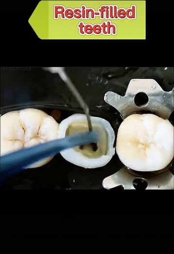 Achieve a Beautiful Smile with Effective Tooth Fillings