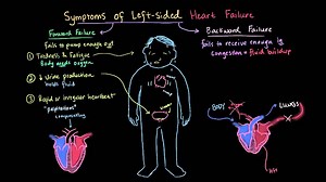 Symptoms of left sided heart failure