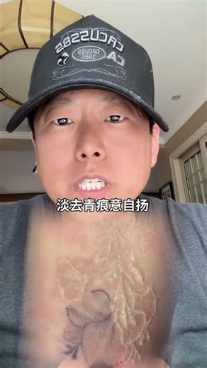 Revolutionary Tattoo Removal in Baoji: Say Goodbye to Ink