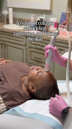 Everesse RF: Skin Tightening & Collagen Stimulation