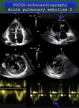 POCUS- echocardiography /Acute pulmonary embolism 2 #cardiology #echocardiography