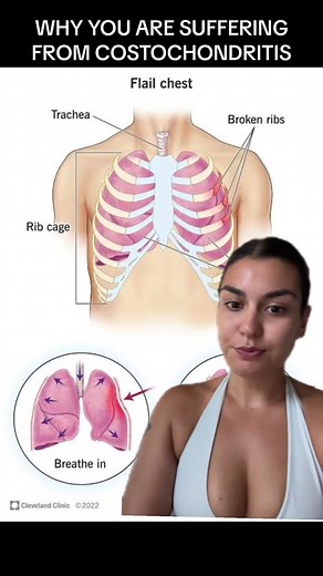 WHY YOU ARE SUFFERING FROM COSTOCHONDRITIS. #costo #costochondritis #inflamation #inflamationrelief #costochondritisawareness #flareup #costochondritisattack #costochondritistreament #costochondritisflareup