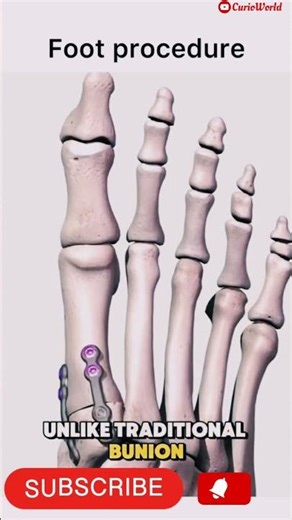Lapiplasty Surgery Explained/3D Bunions Permanently!