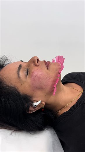 PDO Mono Threads are a fine thread made form Polydioxanone which is an absorbable polyer. This thread is deposited under the skin via a small needle. The thread causes an inflammatory response stimulating neocollagenesis (new collagen formation) causing thicker, tighter skin that can be seen 2-3 months after treatment when the thread has completely dissolved. #threads #pdothreads #cosmeticnurse #skintighening