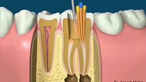 72K views · 266 shares | Root Canal Animation | The dental | Facebook