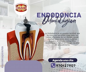 ¿Cuándo es necesario realizar una endodoncia? Se recomienda realizar...