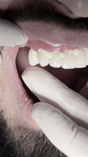 Zirconia bridge to badly destroyed upper teeth, the patient was so happy with the new smile #dentist