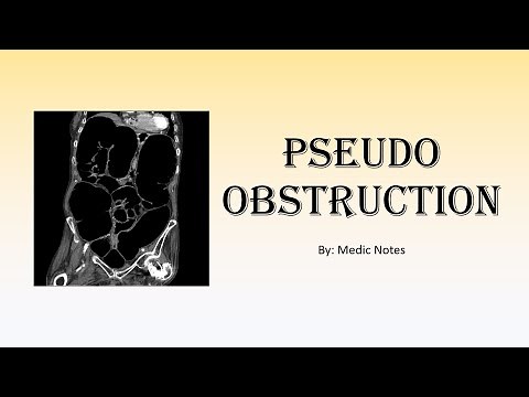 Pseudo-obstruction/Ogilvie syndrome - pathophysiology, clinical features, investigation, treatment