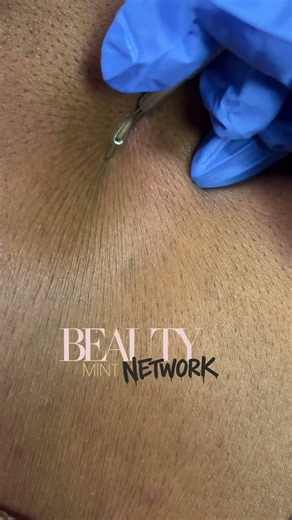Blackhead Removals