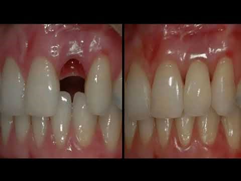 how to grow teeth naturally | Grow Your Own Teeth in Just 9 Weeks - clickbank review