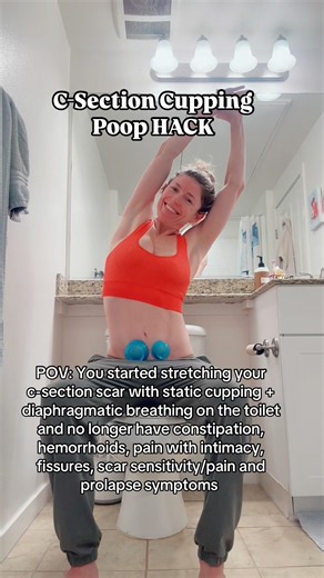 Scar Cupping Poop HACK! #constipation #poop #health #doctor #pt #cupping #massage #csection #mom