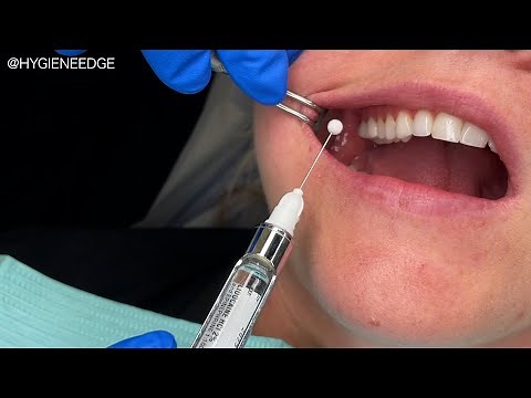 Practicing Injections With the Safe-D-Needle