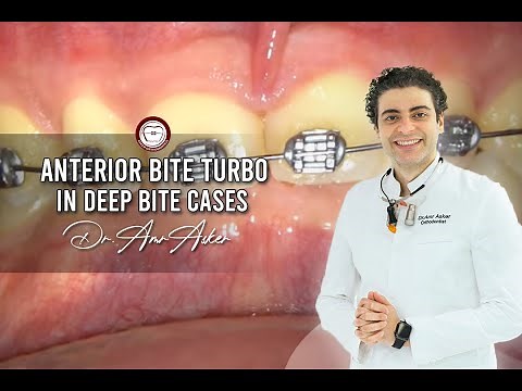 Anterior bite turbo in deep bite cases+bonding lower braces, How to raise the bite in orthodontics