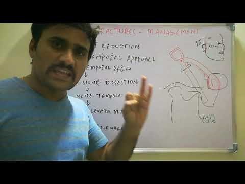 Gillies temporal approach