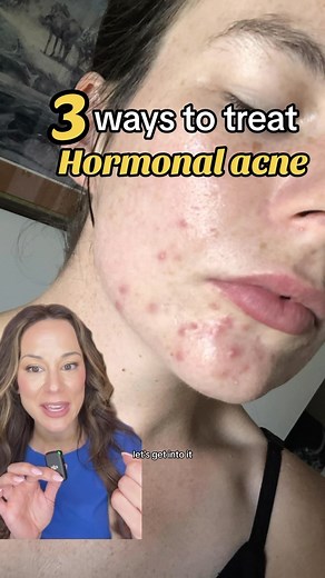 Hormonal acne: how do Derms treat it? Hormonal acne is specific type of acne consisting of cystic, painful lesions located around the jawline, lower face, and neck We don’t know why it happens, but it’s believed to due to sensitivity to hormonal fluctuations. While we have no cure, we do have effective treatments! This type of acne can be painful, frustrating, and lead to self-esteem issues. Be sure to see a dermatologist if you have this type of acne, since it’s difficult to treat with OTC prod