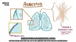 【医学科普】Mesothelioma - causes, symptoms, diagnosis, treatment, pathology【中字】