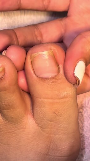 Understanding Melanoma on the Pinky Toe