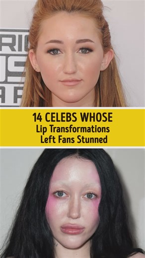 14 Celebs Whose Lip Transformations Left Fans Stunned | Bright Side of Love