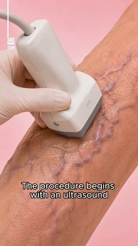 How superglue fixes varicose veins