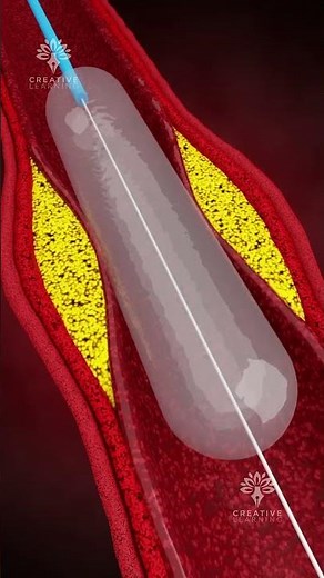 How Does Coronary Angioplasty Work | Blocked Arteries Treatment #shorts - creativelearning3d
