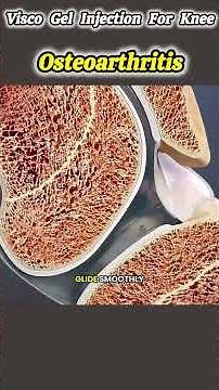 Visco Gel Injection For Treatment of Knee Osteoarthritis(3D Animation)#viscogel #visco#gel#injection