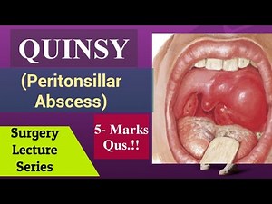 Peritonsillar Abscess(Quinsy)- Surgery Lecture, NEET PG Aspect, in Tonsils, Tonsillitis