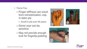 Fingertip Amputations: Local and Regional Flaps. What Is the Simplest Coverage Option Appropriate for My Patient?