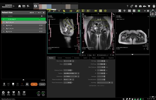 MRI of SI joints full work technique & sequences names 1.t2 tse sagittal LS 2.T1 tse coronal 3.t2 stir coronal 4.t1 tse transverse 5.t2 stir transverse www.ctscanandmri.com "Love what you’re seeing? Tap that Star button and help me keep going!" 🌟🌟🌟 | CT Scan and MRI study