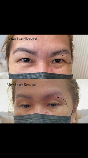 Eyebrows Tattoo Removal - Laser Techniques for Safe and Effective Results