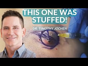 This Cyst Was A Big Gooey Mess!