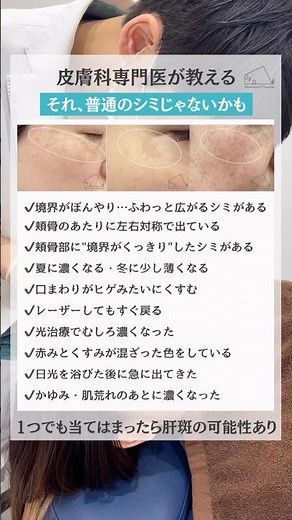 【本当にシミですか？】肝斑セルフチェック【教えます】#美容皮膚科 #皮膚科専門医 #美肌ケア #肝斑
