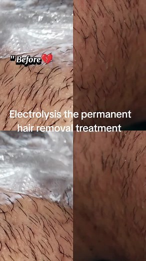 Electrolysis Clinic on TikTok