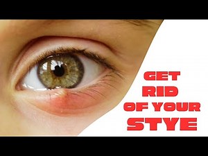 How To Get Rid Of a Stye (Eyelid Infection) - Treatments & Remedies