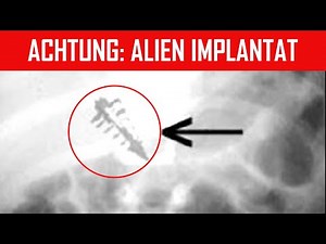Alien Implantat gefunden! - Entführt von Außerirdischen?!
