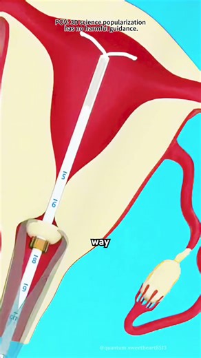 Intrauterine Device (IUDs) For Birth Control (3D Animation)