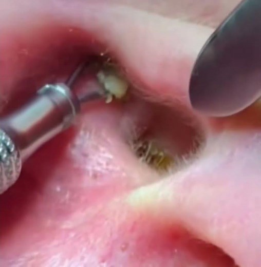 😱 ¡No podía creer lo que salió de aquí! Extracción brutal de punto negro #puntosnegros