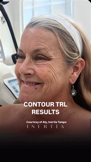 Sciton Inc on Instagram: "From treatment day to total transformation. 🪞✨ This patient trusted the process…and @aly.inertiatampa delivered with her Contour TRL skills. Just 10 days post-treatment, the skin is already showing visible improvement in the appearance of texture. What’s left? A little residual redness, which will continue to fade as the skin heals. ✨ One treatment. Real results. ✨ Continued improvement over the weeks ahead. 💬 Patients: Curious if TRL is right for you? Start the convo
